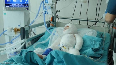 طفلة سورية تفطر القلوب.. نزحت 7 مرات ثم احترقت في مخيم (صور)