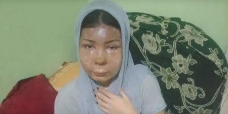 رفضت الزواج منه فصب مياه نار على وجهها.. مأساة شابة  صور