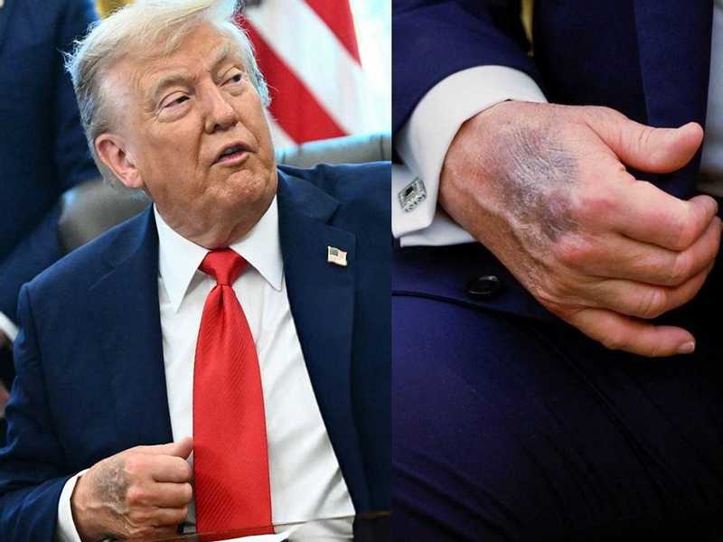صورة حديثة ليد ترامب.. الكدمة التي لا تخفيها مساحيق التجميل تجدد الجدل (شاهد)