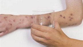 وفاة طالب بالسحايا البكتيرية في الطفيلة.. وفحوصات المخالطين سليمة